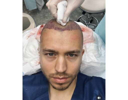 Прощай, лысина: Сергей Романович сделал операцию по пересадке волос